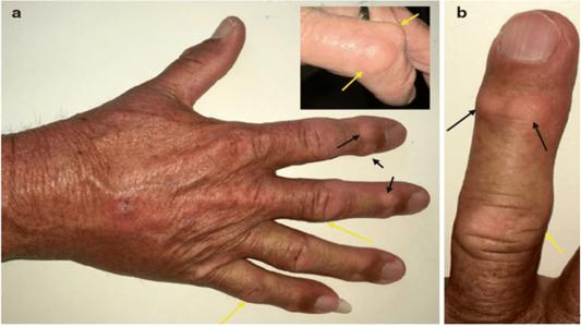手指骨关节炎有什么治疗方法？手指骨关节炎的偏方治疗？